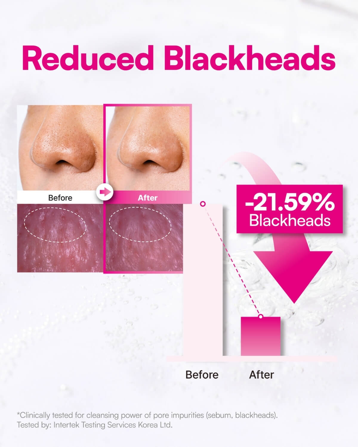 Before and after comparison photos showing a 21.59% reduction in blackheads after using the cleansing oil.