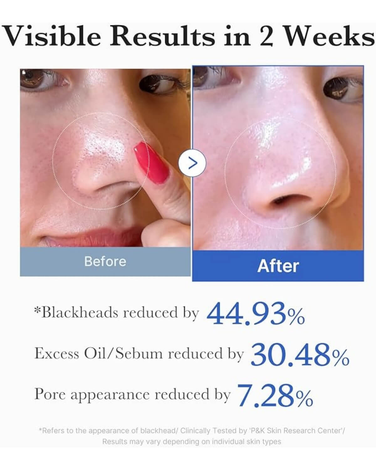 Medicube Zero Pore Pad 2.0, infographic - model showing results after 2 weeks of using, blackheads reduced by 44.93, excess oil//sebum by 30.48%, pore appearance by 7.28%