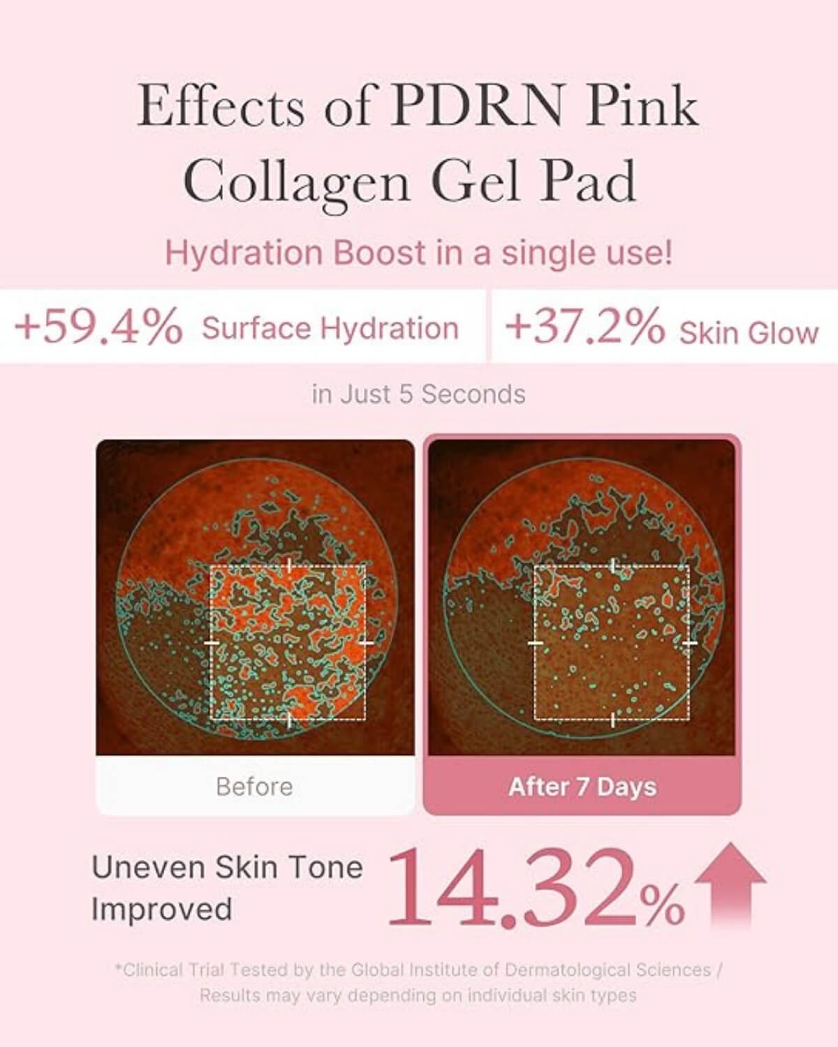Medicube PDRN Pink Collagen Toning Gel Toner Pad, infographic - effects of PDRN Pink Collagen Gel Pad, before and after 7 days use, improved uneven skin tone by 14.32%