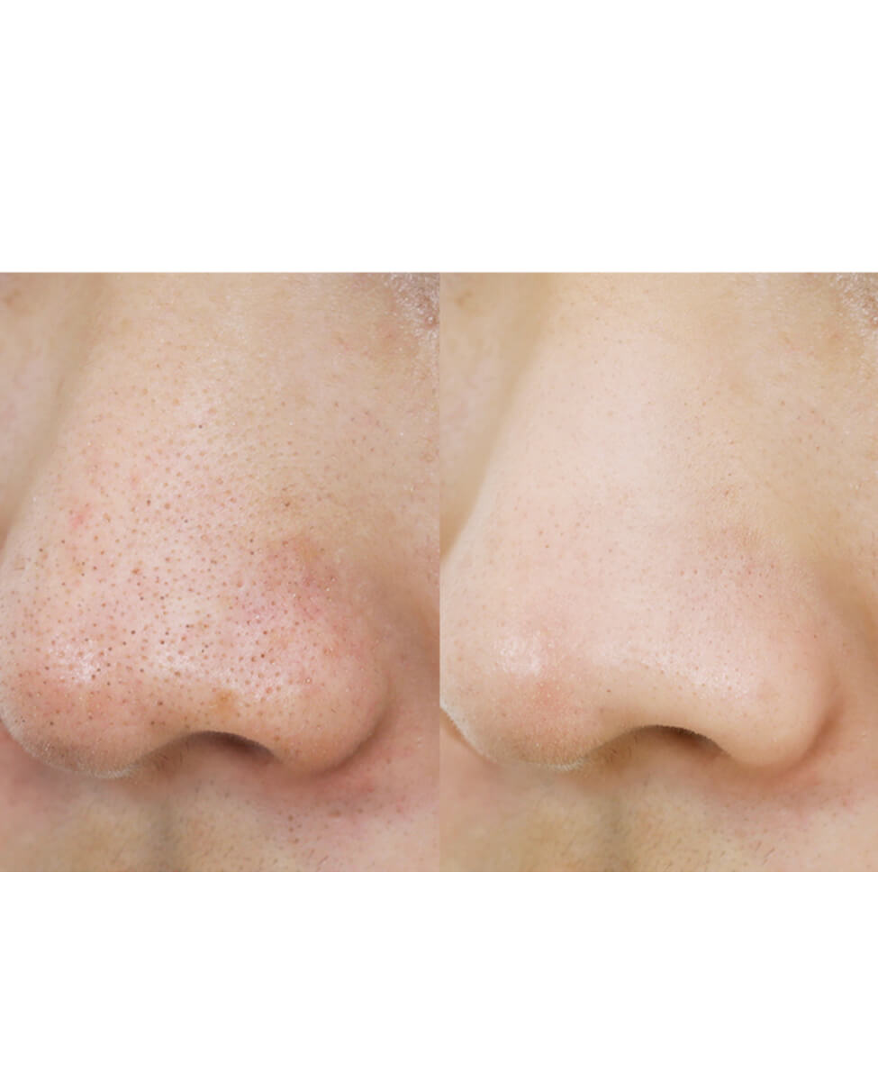 ma:nyo Pure Cleansing Oil_Clarifying Oil Cleanser_before and after, first cleanser, oil cleanser, clear skin