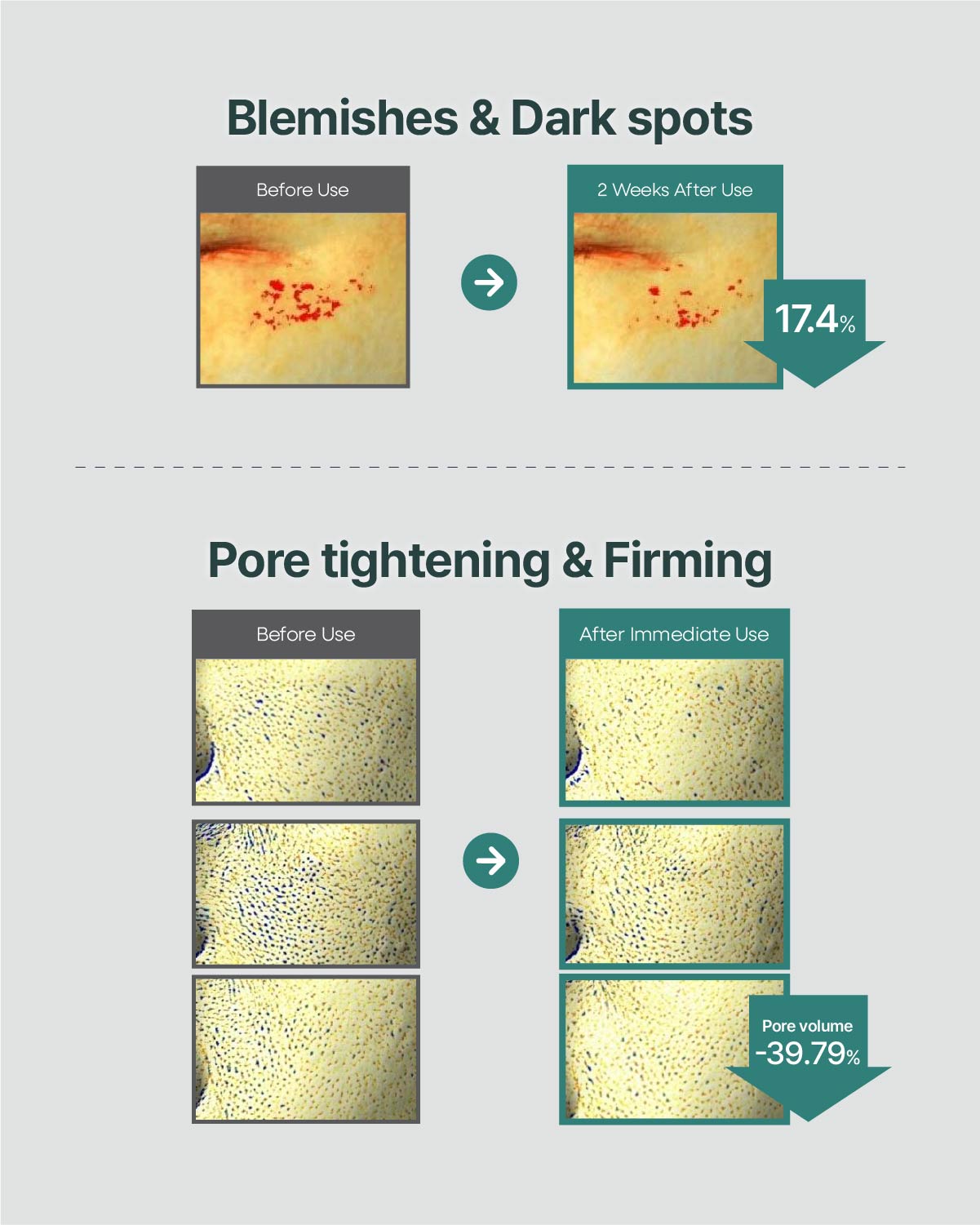 Before and after clinical results showing 17.4% reduction in dark spots and 39.79% reduction in pore volume.